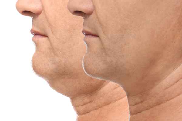 HIFU - Breakthrough in Anti - ageing 2 hifu results Rugby