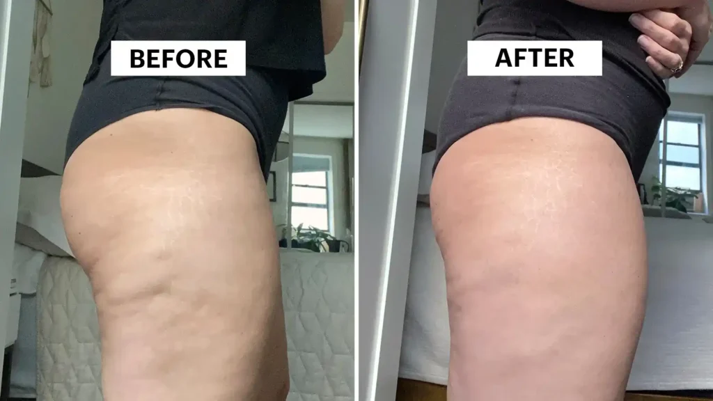 Sculpting Your Bum: Can Toning Exercises Really Reduce Cellulite? 1 Do Toning Exercise Rugby Really Tackle Cellulite?