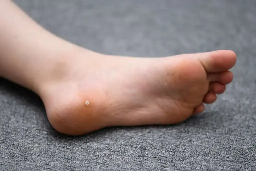 Cryotherapy For Warts And Also Verrucas 2 Image of verruca on the bottom of the foot that able to be treated with Cryotherapy Rugby