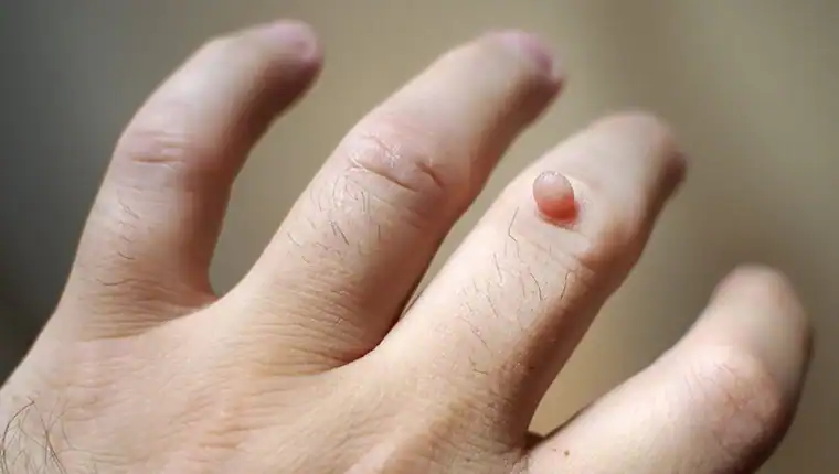 Cryotherapy For Warts And Also Verrucas 1 Image of blemish that Cryotherapy Rugby can remove with Lipo 360.