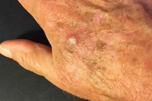 Cryopen For Actinic Keratoses 1 Image of Actinic keratoses Rugby on a person hand