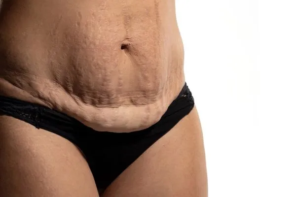The Science of Skin Tightening 1 The science behind skin tightening Rugby picture of a woman's sagging skin on the stomach